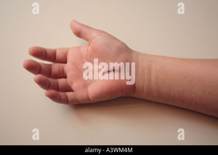 Hand with stitches from carpal tunnel surgery Stock Photo