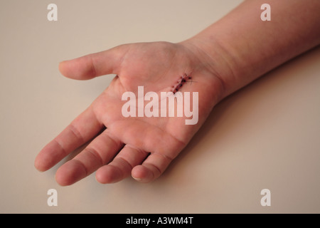 Hand with stitches from carpal tunnel surgery Stock Photo