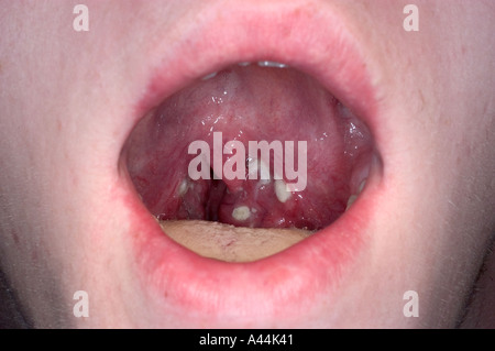 strep throat infection Stock Photo