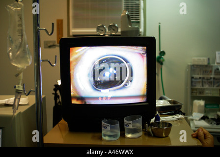 Eye surgery (Cataract) on a monitore in the surgery room, Recife, Brazil Stock Photo