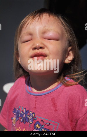 Three year girl with swollen forehead and closed eyes from mosquito bites Stock Photo