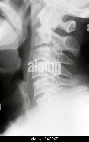 X ray normal cervical spine Stock Photo - Alamy