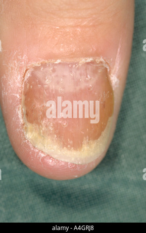 NAIL DYSTROPHY Stock Photo: 52502477 - Alamy