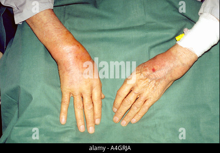 Arthritis resulting from a pyogenic infection of the joint cavity Stock Photo