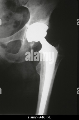 An x-ray showing a Harris-Galante Total hip replacement of the left hip for osteoarthritis. Stock Photo