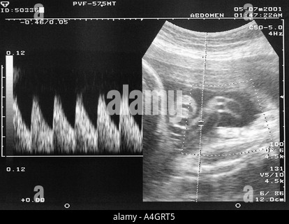 Ultrasound scan - normal umbilical artery Dopplers Stock Photo - Alamy