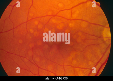 A retinal photograph showing the retina after laser treatment for retinopathy Stock Photo