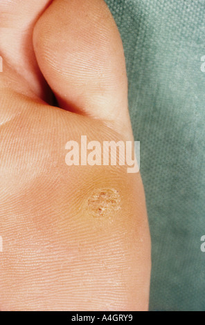 VIRAL WARTS ON SOLE OF FOOT Stock Photo - Alamy