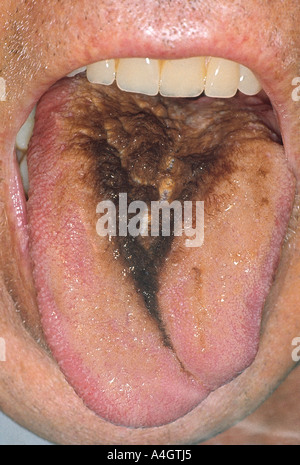 Hairy tongue is an uncommon, benign condition that is also known as black hairy  tongue or lingua nigra Stock Photo