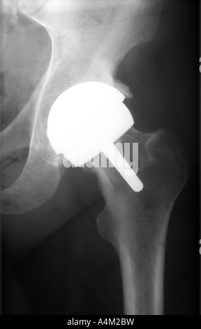 X ray Photograph of Hip showing Birmingham Hip  Replacement Prosthesis Stock Photo