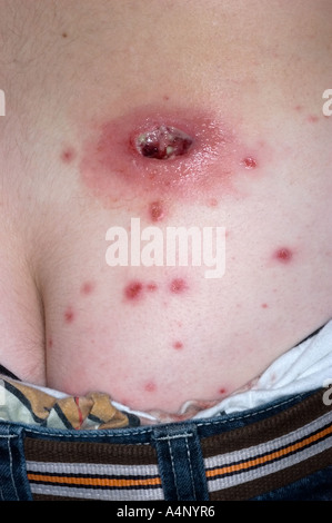 methicillin resistant staph aureus skin infection Stock Photo