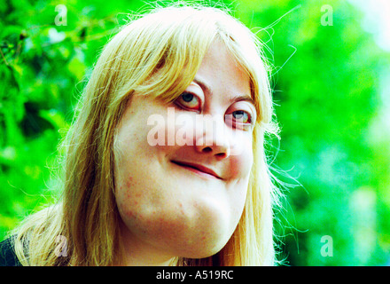 A young woman with cherubism.  The rare genetic condition  is a hereditary  form of  polyostotic fibrous dysplasia. Stock Photo