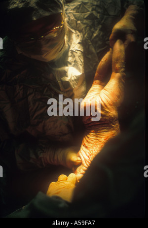 Baby being delivered by Caesarian section by doctor in hospital. Stock Photo