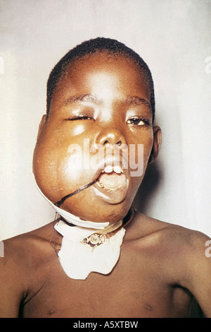 This Nigerian child presented with a large facial tumor due to malignant Burkitts lymphoma Stock Photo