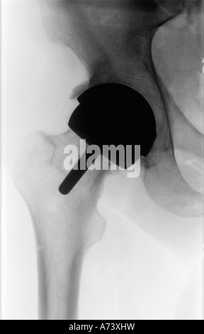 X ray Photograph of Hip showing Birmingham Hip Replacement Prosthesis Stock Photo