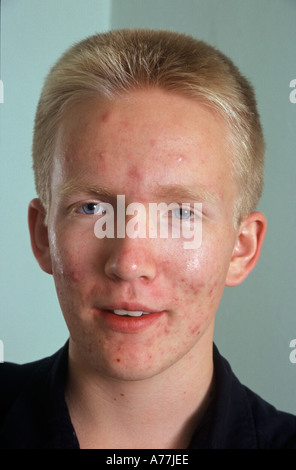 portrait of teenage boy with acne Stock Photo