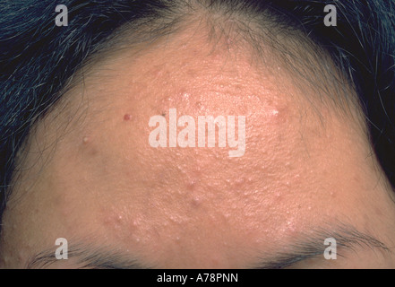 Acne medicamentosa Stock Photo 1683535  Alamy