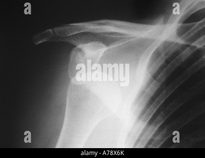 X-RAY - DISLOCATED SHOULDER Stock Photo