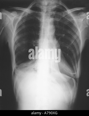 Chest x-ray showing a right lower lobe pneumonia Stock Photo - Alamy