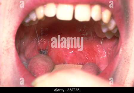 peritonsillar abscess Stock Photo: 589511 - Alamy