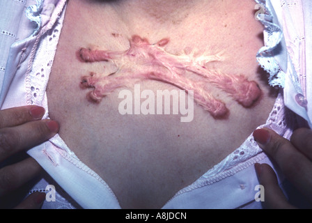 Keloid scar on woman's chest. Stock Photo