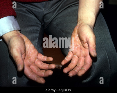 Ringworm of the hands (tinea manus) particularly the palms and the spaces between the fingers. Stock Photo