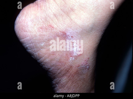 Fungal infection rash (tinea) on patient's ankle. Stock Photo