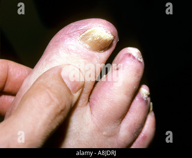 Kaposi sarcoma lesions hi res stock photography and images Alamy