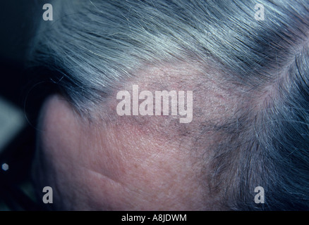 Alopecia areata is a localized loss of hair. Stock Photo