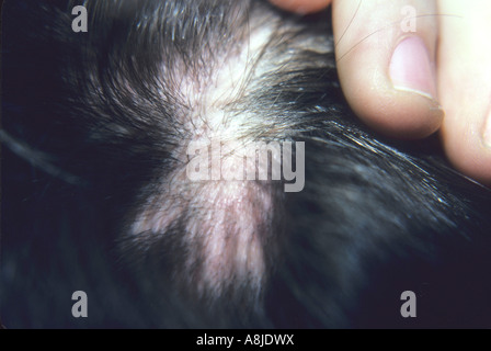 Alopecia areata is a localized loss of hair. This image may not be  model released due to non-recognizable person in image. Stock Photo