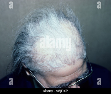 Alopecia areata is a localized loss of hair. Stock Photo