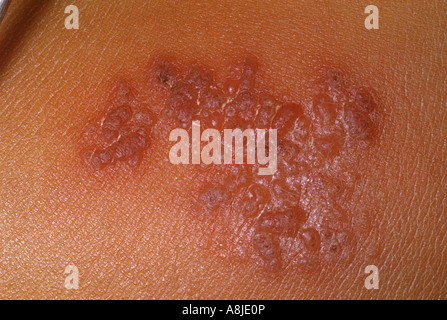 Herpes zoster on a childs back Herpes virus varicella. Stock Photo