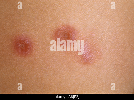 Impetigo Stock Photo, Royalty Free Image: 4055160 - Alamy