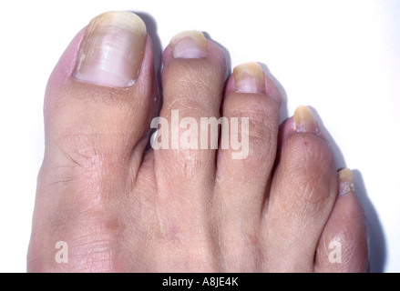 Tinea unguium effecting the toe nails. Onychomycosis fungus from t ...