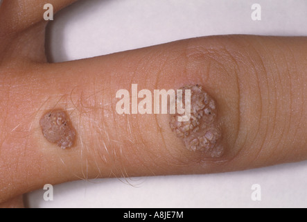 hpv warts skin tags private parts