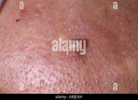 Wart on chin caused by the HPV - Human Papilloma Virus Stock Photo