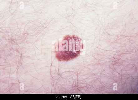 DYSPLASTIC NEVUS Stock Photo: 49303809 - Alamy