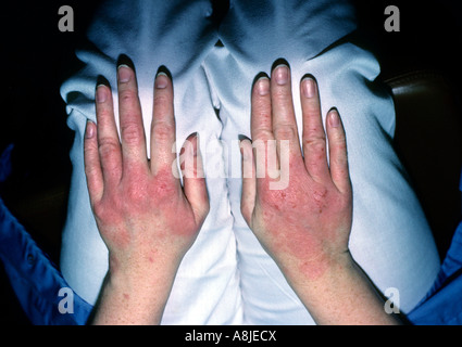 Skin rash of eczema on the hands of a 52 year old female Stock Photo ...