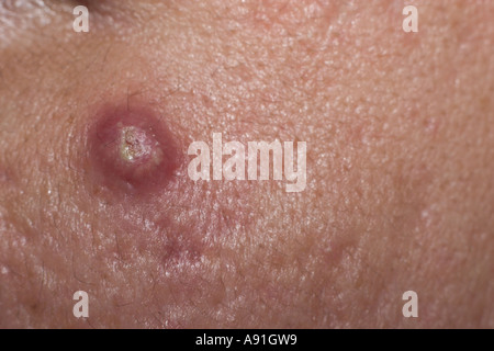 large pimple on oily face Stock Photo