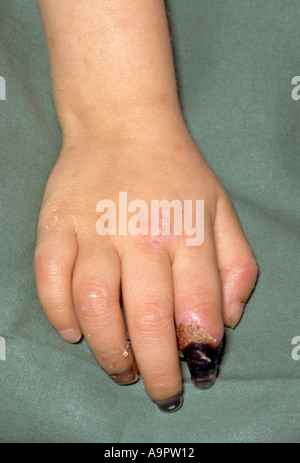 Meningococcal disease gangrene Stock Photo