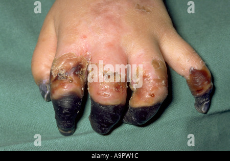Necrotic fingers meningococcal disease Stock Photo