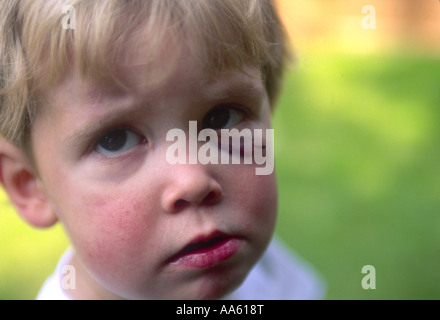 Young boy child with black eye. bruised face, looking sad Stock Photo