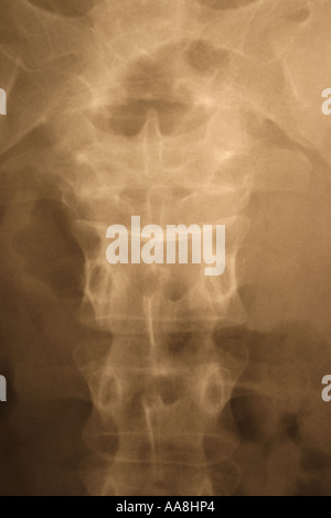 XRAY OF THE FEMALE ABDOMINAL REGION VERTICAL BAPDB7317 Stock Photo