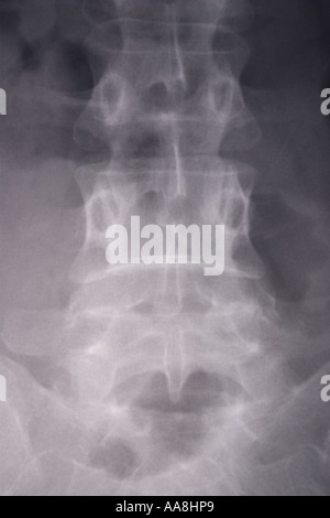 XRAY OF THE FEMALE ABDOMINAL REGION VERTICAL BAPDB7320 Stock Photo