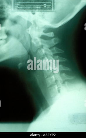 Photo of x-ray film on light panel, chiropractor Stock Photo