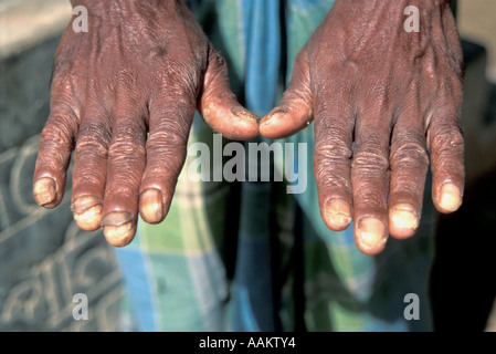 Rural Life – Symptoms of Arsenicosis - ‘Devil’s Water’ ‘Biggest mass ...