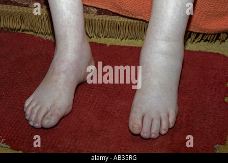 Swollen Extremities My Terrifying Cancer Diagnosis - 97d0kch