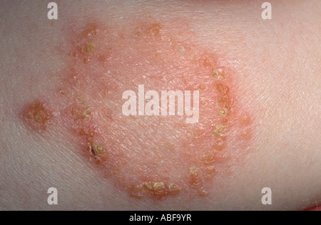 IMPETIGO Stock Photo - Alamy