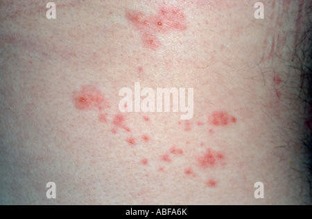 Disseminated Herpes Zoster Thoracic Herpes Zoster