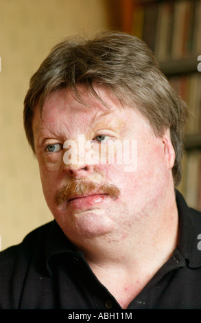 Simon Weston suffered terrible burns when RFA Sir Galahad was bombed during Falklands war 1982 while serving with Welsh Guards Stock Photo